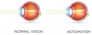 Eye diagram for normal vision and astigmatism